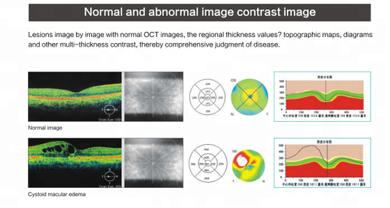 Spectral Domain OCT Optical Coherence Tomography for ophthalmology department