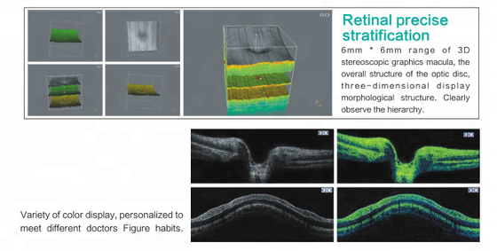 Spectral Domain OCT Optical Coherence Tomography for ophthalmology department