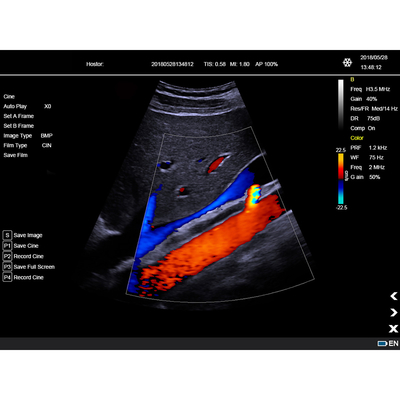 Color Doppler Portable Ultrasound Machine Medical USG PW CW DICOM Cardiac Probe Cardiology for Hospital Clinic
