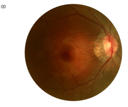 factory price for the auto Capture and Auto Flash Fundus Camera for Retinal Examination